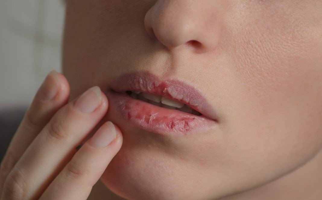 Dermatillomania skin picking. Woman has bad habit to pick her lips. Harmful addiction based on anxiety stress and dry lips. Excoriation disorder. Sick cracked damaged tissue. 3 Health Tips For The Harmattan Season