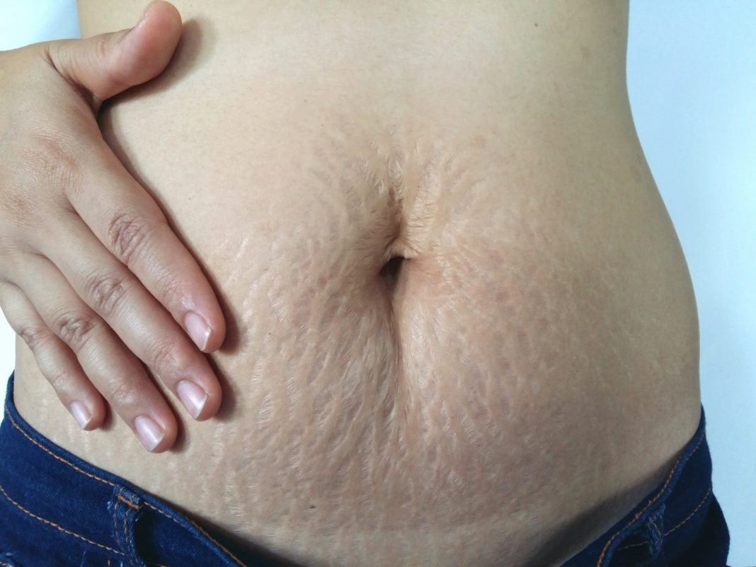 5 Ways To Get Rid Of Stretch Marks Naturally 5 Ways To Get Rid Of Stretch Marks Naturally