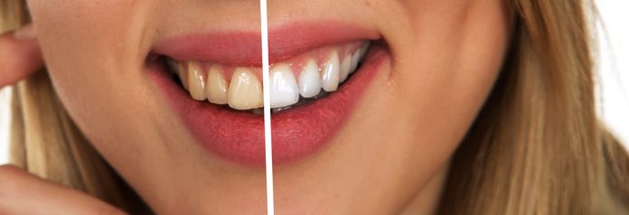 How To Whiten Your Teeth at Home