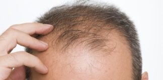 5 Causes Of Hair Loss 5 Causes Of Hair Loss