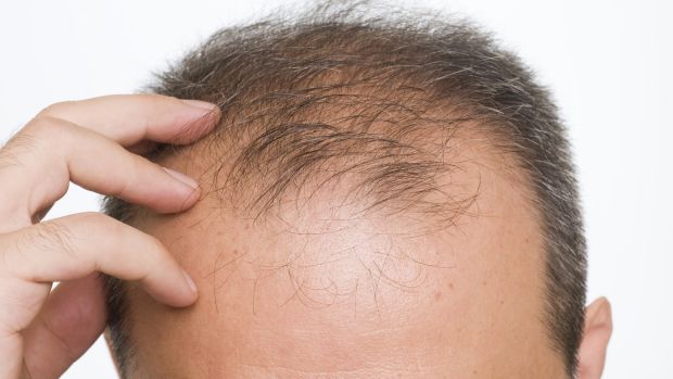 5 Causes Of Hair Loss